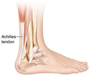 Running with outlet achilles bone spur