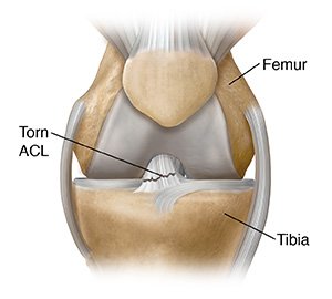 ACL Tear  Sarah Bush Lincoln