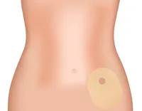 Ostomy.png