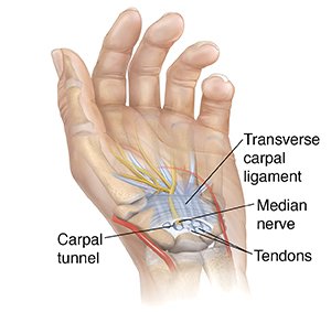 Median Nerve Entrapment, It's More Than Carpal Tunnel